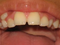 /album/fotogaleria-inicio1/eliminacion-de-la-placa-microbiana-jpg1/